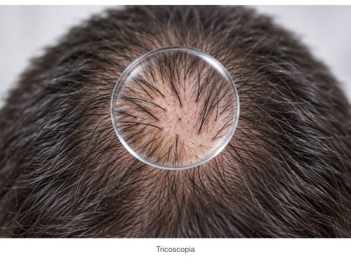 Diagnosi differenziale delle alopecie: approccio clinico e tricoscopico prima dell’indicazione chirurgica